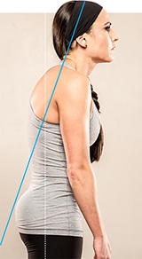 Posture disorders: upper cross syndrome